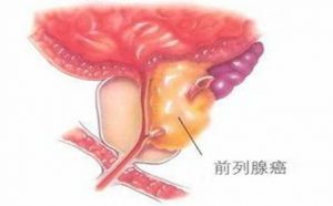 恩杂鲁胺有成为治疗前列腺癌标准的潜力