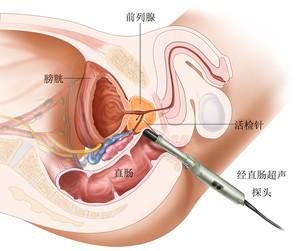 这4种人易患前列腺癌